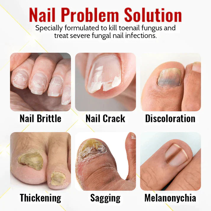 NailFungus® Aceite Rejuvenecedor de Uñas - Elimina Hongos y Fortalece en Semanas