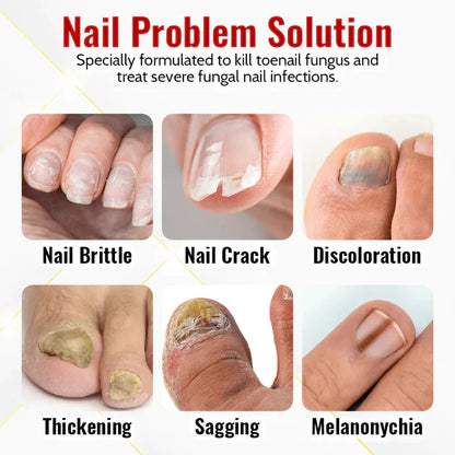 NailFungus® Aceite Rejuvenecedor de Uñas - Elimina Hongos y Fortalece en Semanas