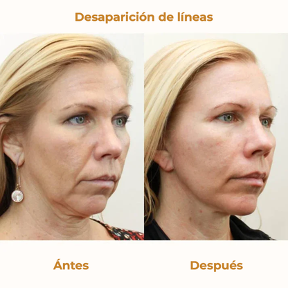 StopWrinkle® - Parches Rellenadores para Arrugas e Imperfecciones