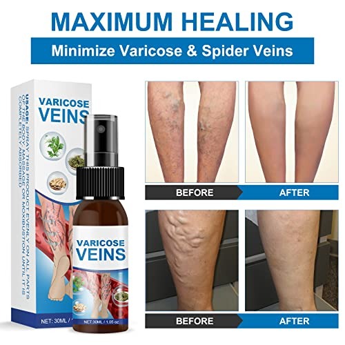 VeinsEase® Spray - Libérate del Dolor de Piernas y las Varices Hoy Mismo