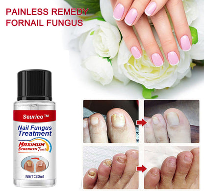 NailFungus® Aceite Rejuvenecedor de Uñas - Elimina Hongos y Fortalece en Semanas